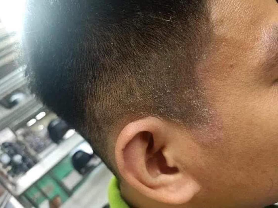 BÔi CHÀM VẨY NẾN DA ĐẦU, NẤ.M ĐẦU - NẤ,M DA ĐẦU, GÀU NGỨA MẢNG Vùng đầu