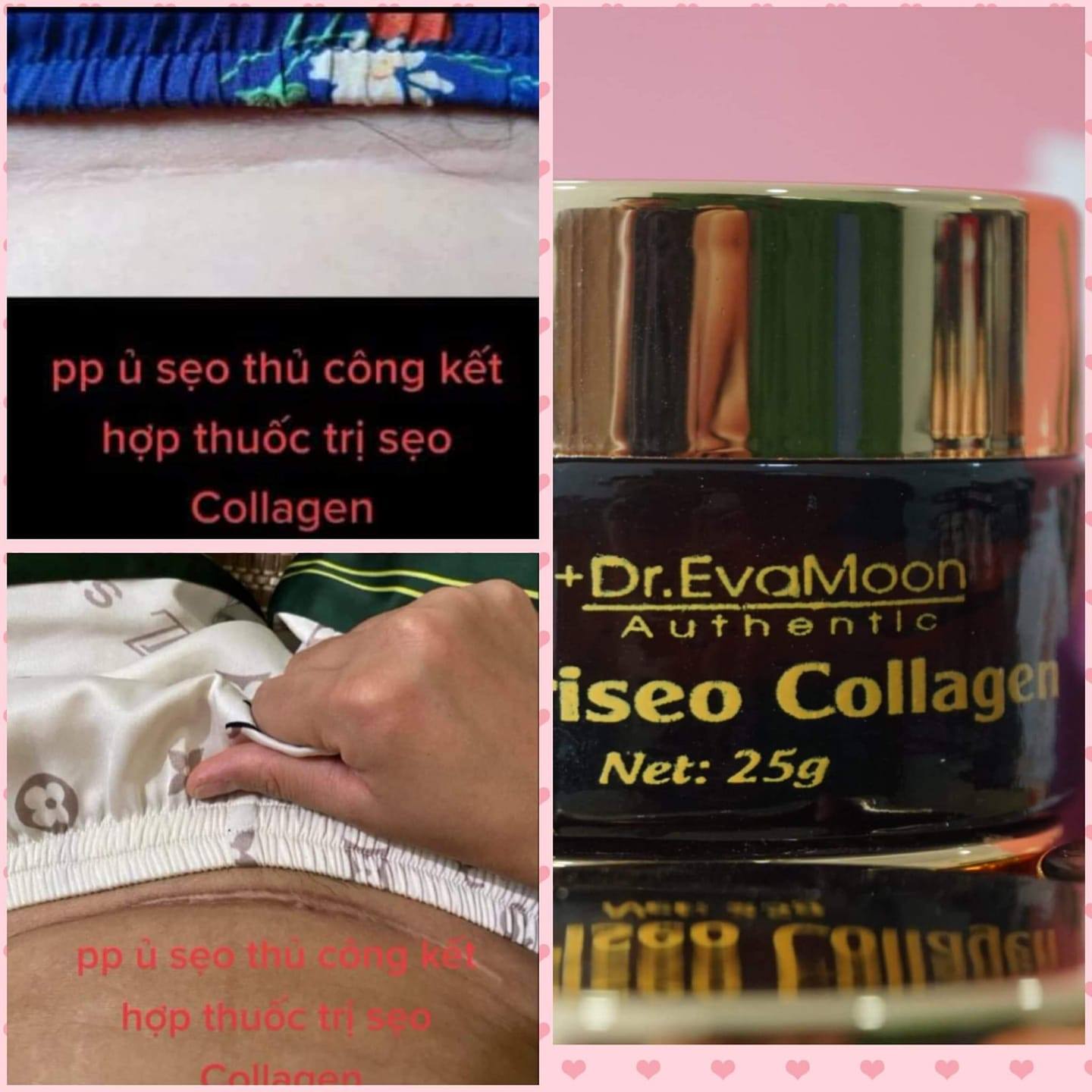 Cao sẹo collagen trị tất cả các loại sẹo dr Eva