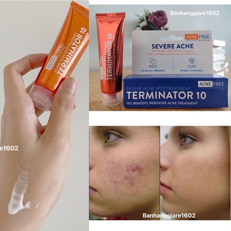 Kem Chấm Mụn AcneFree Terminator 10 Acne Spot Treatment with 10 Maximum Strength Benzoyl Peroxide