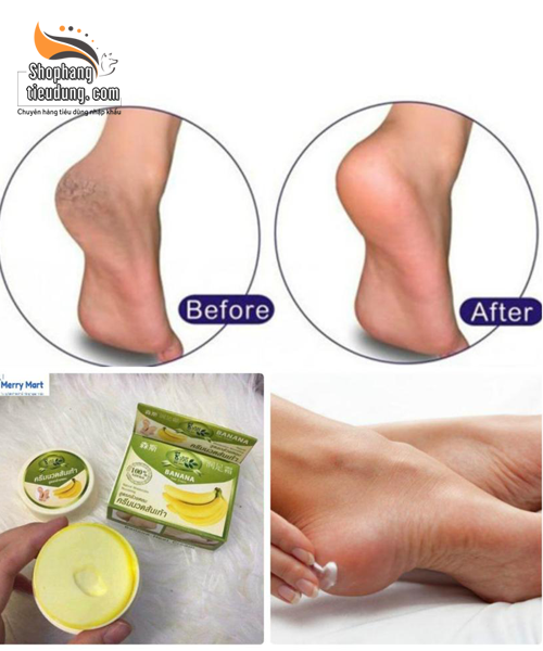 [HCM]Kem tri. Nứt Gót Chân Thái Lankem chuối bôi trả lại bạn gót chân xinh