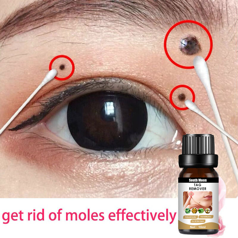 Kem xóa nốt ruồi Làm đẹp da Melanin Spot Herbal Wart Ointment