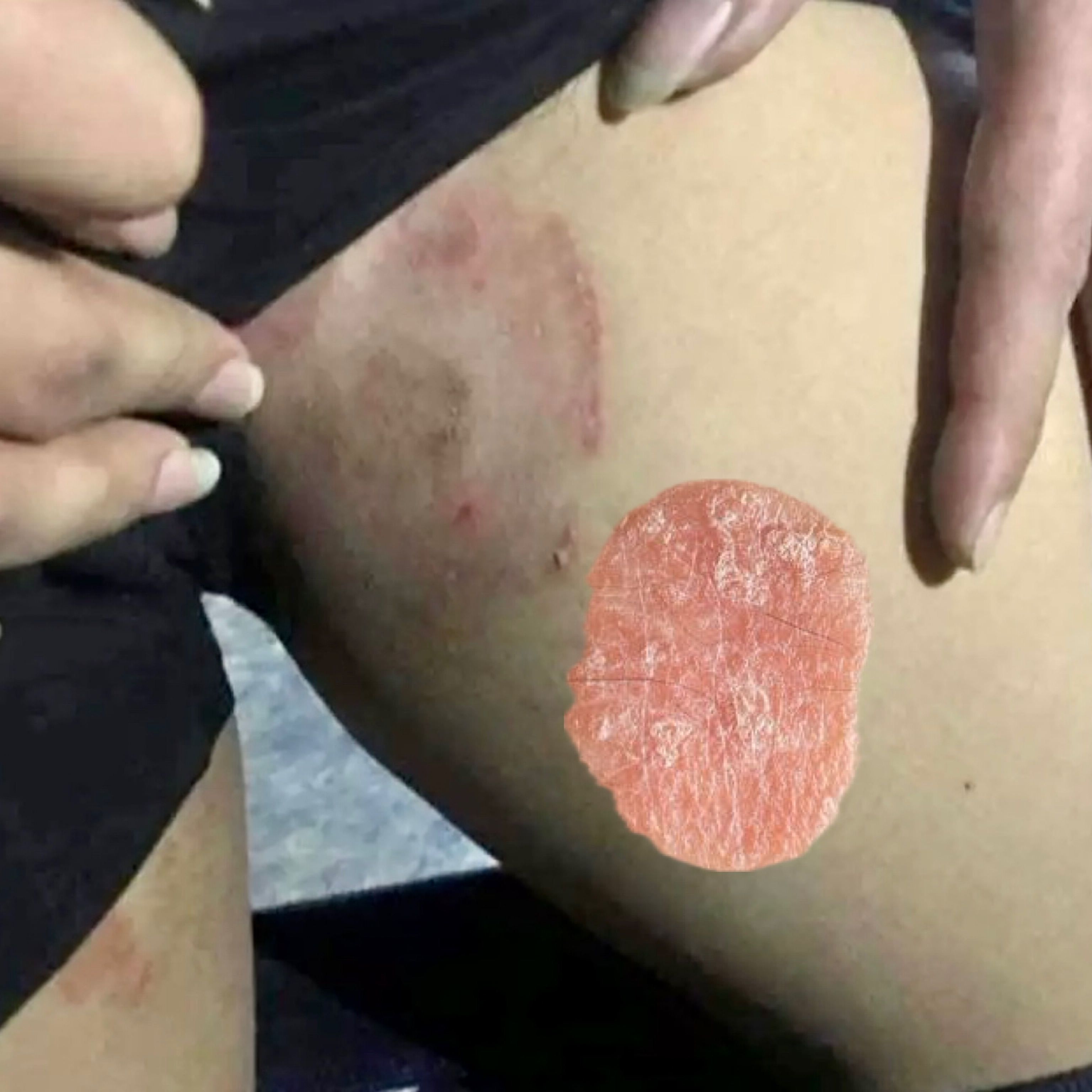Hộp BÔi Chàm đồng tiền - Hắc lào, Đánh bay Nấm Bẹn, Chàm Eczema CỰC HIỆU QUẢ Cải thiện các vấn đề Da Liễu kem Chàm da chăm sóc ngoài da