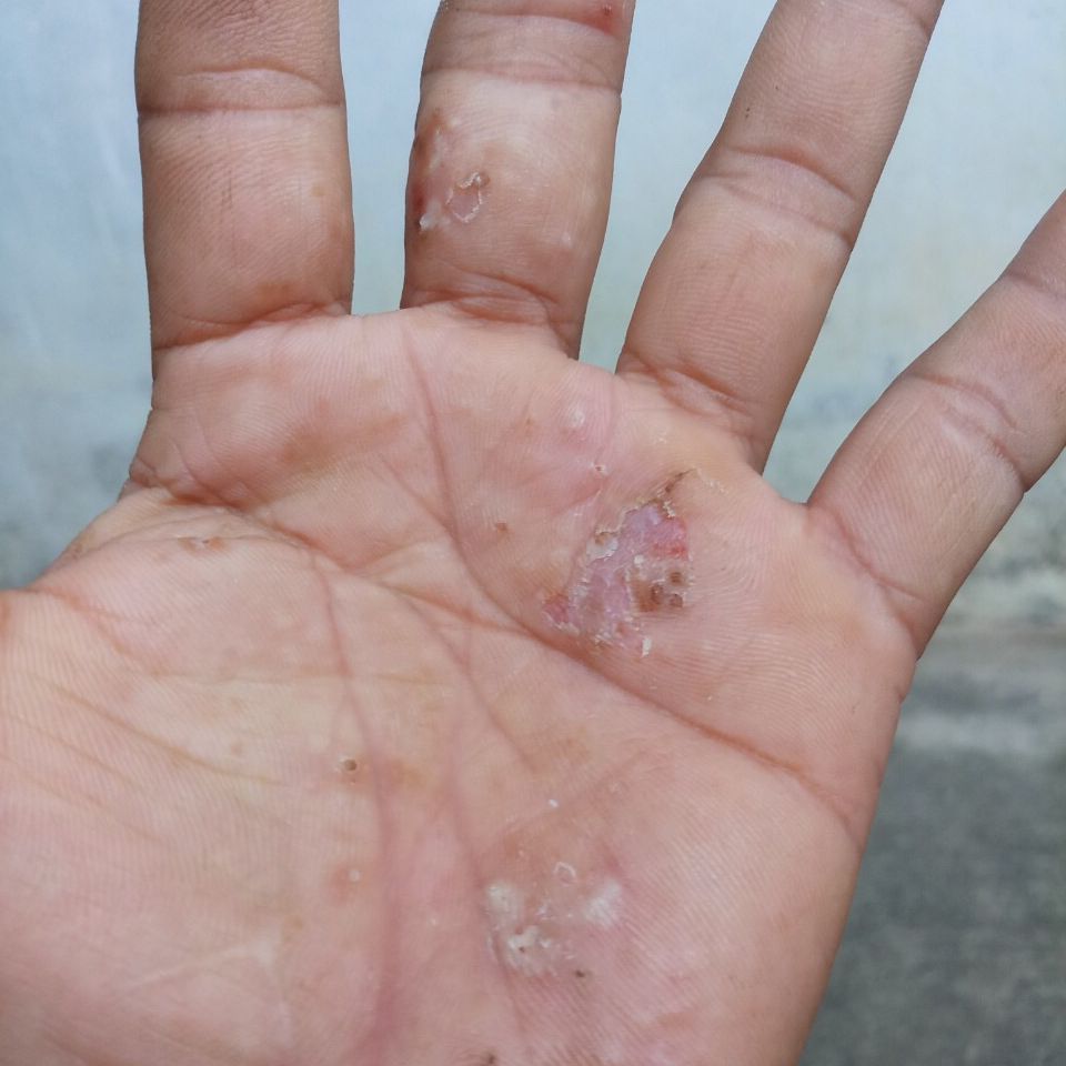CHÀM TỔ ĐỈA, BÔi CHÀM ECZEMA, NẤM TỔ ĐỈA - GHẺ NƯỚC, Mụn Nước Rất Ngứa, kem tẩy tế bào chết tay chân