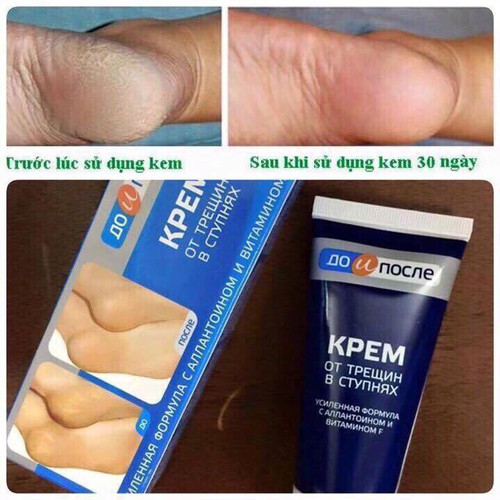 Kem nứt gót chân nga kpem apteka nga chuẩn