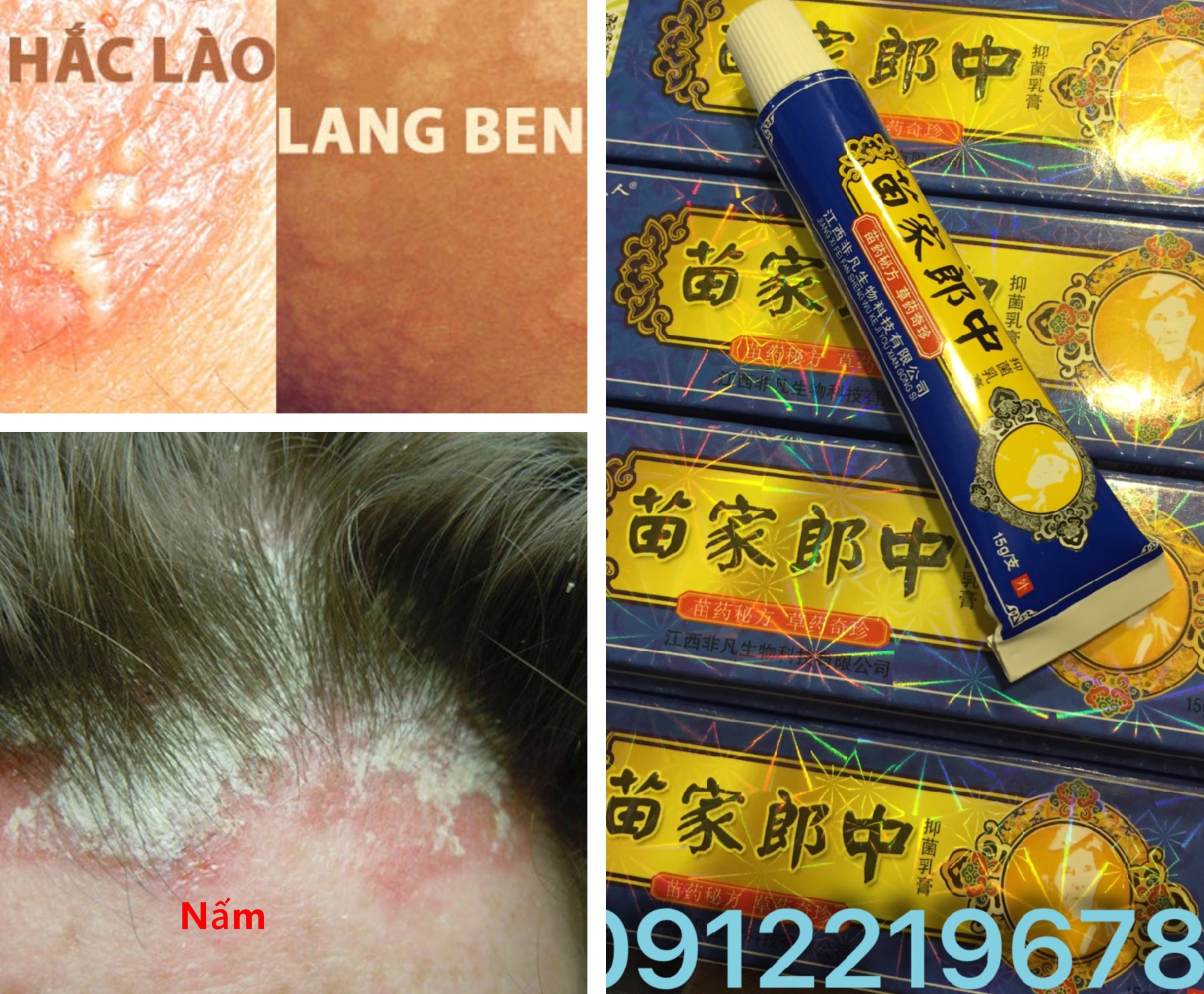 nấm da đầu, viêm da cơ địa