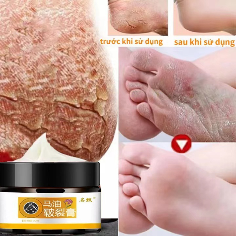 Kem dầu ngựa, kem sửa chữa bàn tay và bàn chân, kem dưỡng tay chống nứt nẻ , sửa chữa và giảm nứt tay và gót chân, nhiễm nấm bàn chân, chống nứt nẻ chất lượng cao, chuyên dụng cho bôi gót chân nứt nẻ 30g