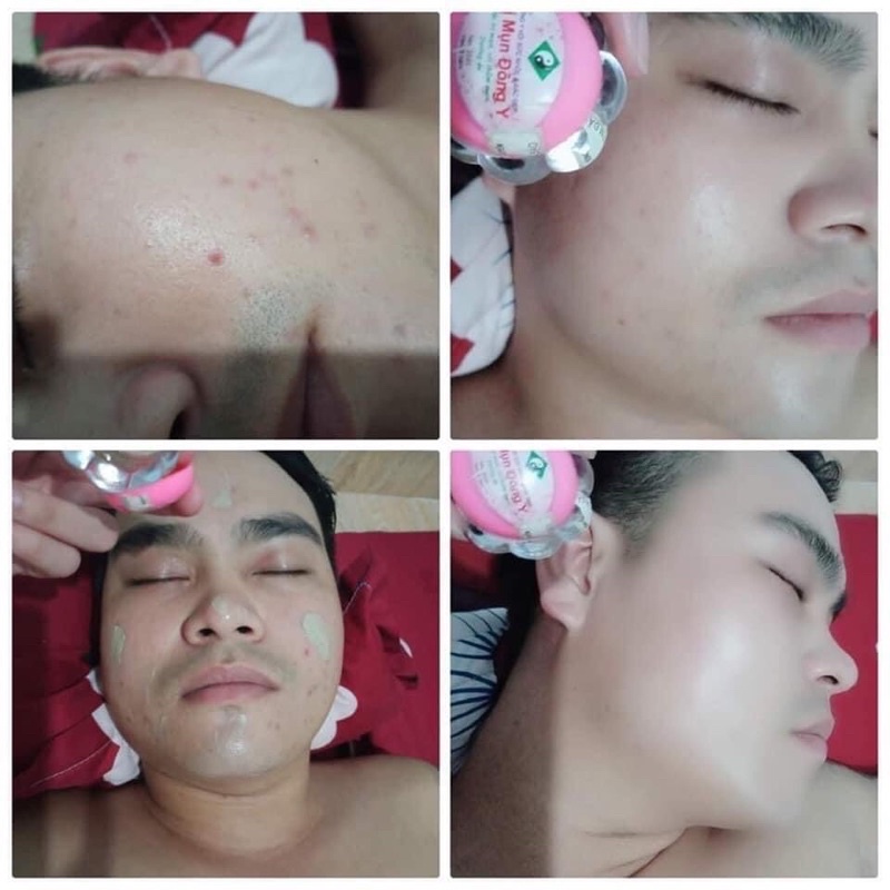 Kem mụn đông y hoa đào hộp lớn 18g, kem mụn hoa anh đào sạch mụn mờ thâm giảm nám