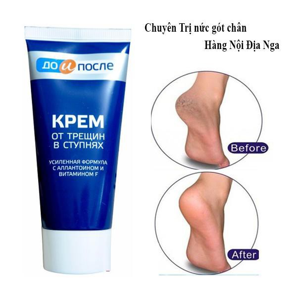 ( HÀNG NHẬP KHẨU) Kem CHỊ nứt nẻ gót chân Kpem của Nga sản phẩm đa dạng về mẫu mã kích cỡ chất lượng tốt đảm bảo an toàn sức khỏe người dùng
