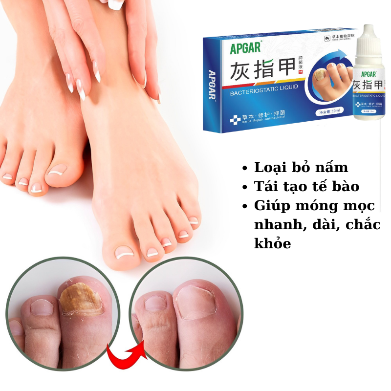 Inh chất chiết xuất thảo dược giảm nấm móng tay chân kháng khuẩn giá siêu tốt Serum Dung Dịch loại bỏ Nấm Móng 10ml