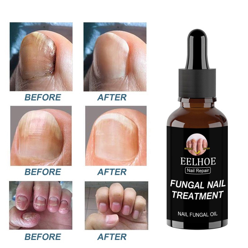 Serum nấm móng | tinh chất thảo dược giảm tình trạng nấm móng, nứt móng, bong sứt móng, dưỡng móng tay chân
