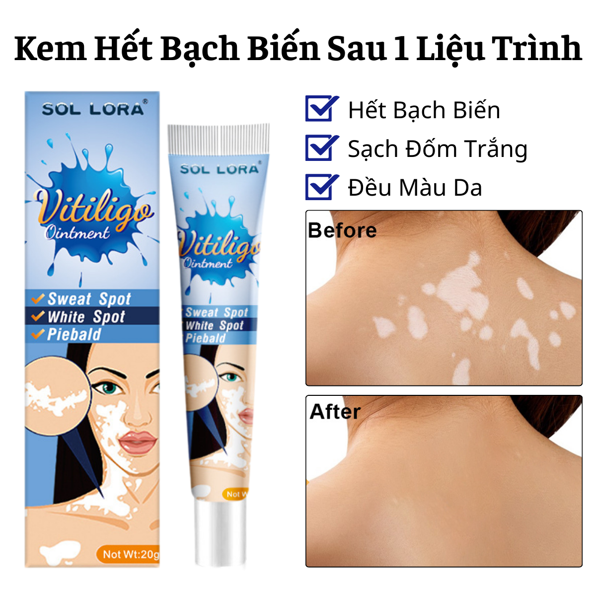 Kem Bôi Hết Bạch Biến Loại Bỏ Đốm Trắng Trên Cơ Thể Lấy Lại Làn Da Đều Màu