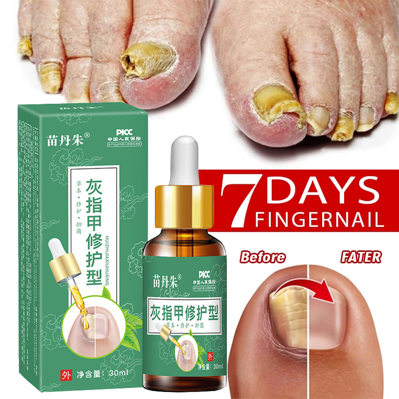 Goblin Fungal Nail Treatment Oil Foot Repair Essence Toe Nail Fungus