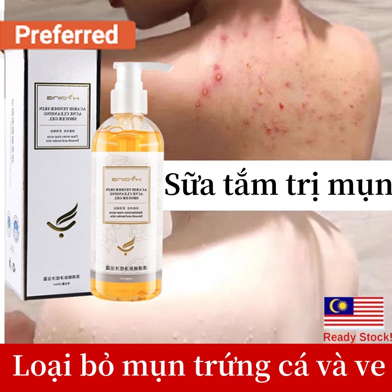 Sữa Tắm Hết Mụn 260ml sữa tắm mụn lưng viêm nang lông Làm Trắng Mịn Da Dưỡng Ẩm Chăm Sóc Phục Hồi Da Cải thiện mụn