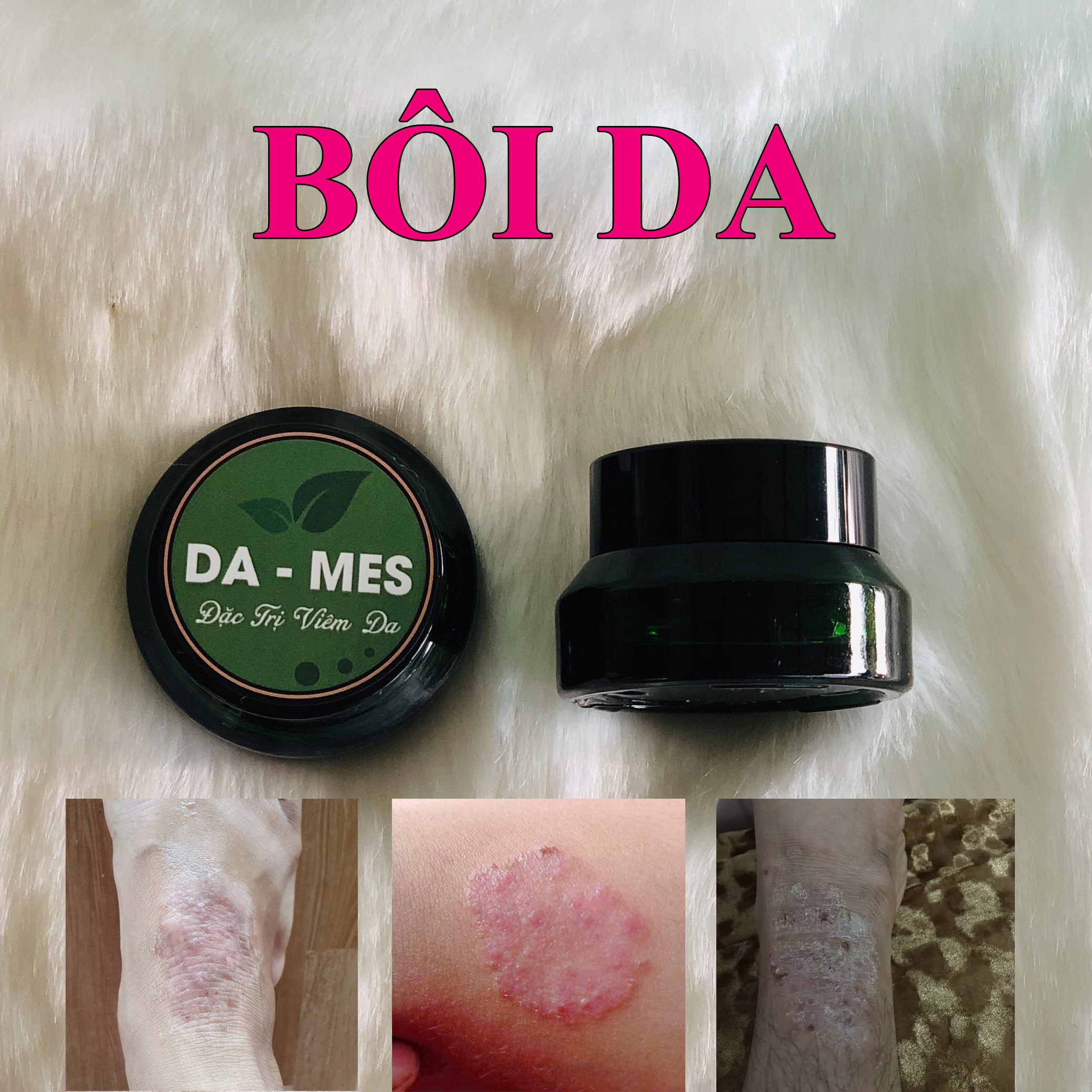 Bôi da DDAAMES Viêm da, vẩy nến, á sừng, hắc lào, nấm da các loại