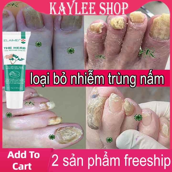 Kem Tẩy Nấm Móng, huyết Thanh Sửa Móng Tay,Gel Tẩy Nấm Chân 15g Loại Bỏ Nấm, Phục Hồi Móng Hư Tổn, Cho Móng Thẳng Chắc Khỏe,Tinh chất dưỡng móng tay và móng chân loại bỏ nấm nhiễm trùng hiệu quả nhanh dùng cho nam và nữ