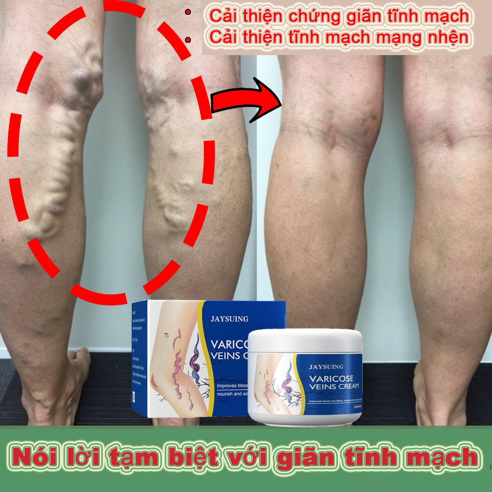 Giãn tĩnh mạch COD kem giãn tĩnh mạch chân bôi trơn thuốc mỡ bôi trơn gel 50g