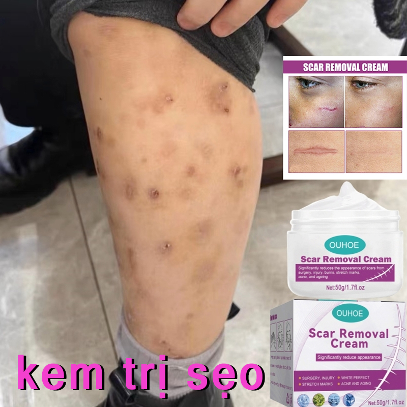 Kem trị sẹo Vết sẹo hỗ trợ trị sẹo, mờ thâm, rạn da Giảm Mụn bỏng phẫu thuật scar esthetique thuốc điều Trị