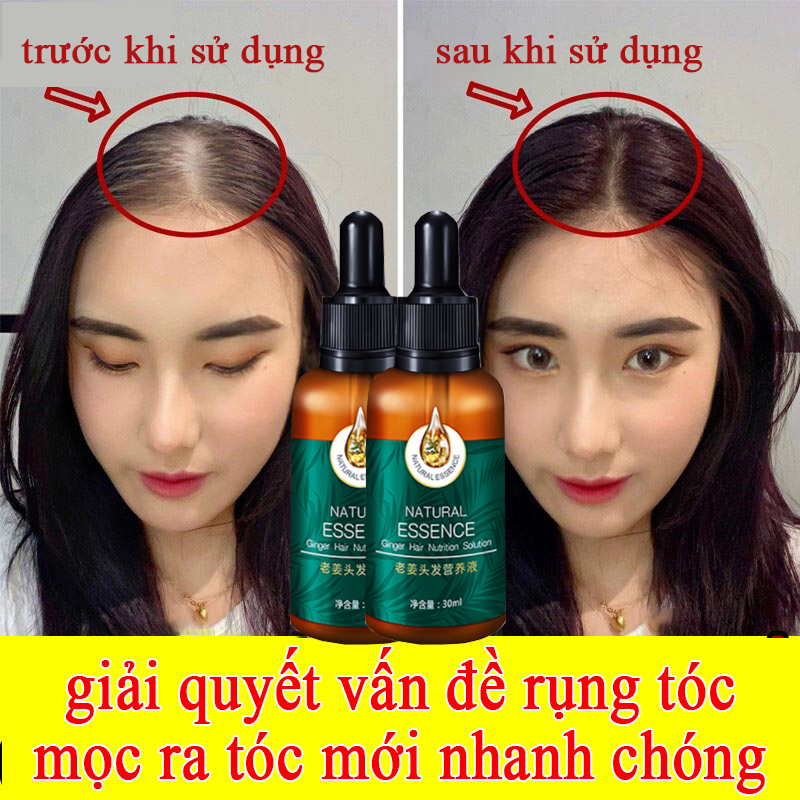 Thuốc mọc tóc kích thích mọc tóc thuốc mọc tóc nam nhanh dầu gội mọc tóc thuốc kích mọc tóc 30ml tinh chất mọc tóc gừng tươi cải thiện xơ rối dưỡng ẩm mềm mượt mái tóc dùng cho cả nam và nữ