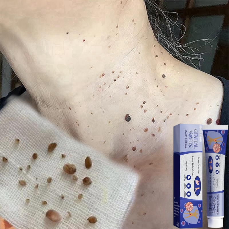 Kem mụn cóc 20g Kem xóa rốt ruồi Gel tẩy nốt ruồi mụn cóc mụn thịt mụn mụn thit Nhanh chóng và hiệu quả làm mờ sẹo ruồi trên mặt tàn nhang mụn cóc mụn thịt mụn cơm mắt cá tại