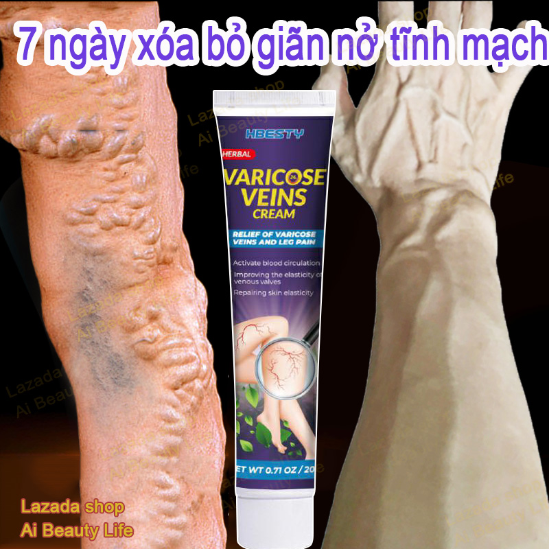 7 ngày xóa bỏ giãn nở tĩnh mạch xóa bỏ tĩnh mạch mạng nhện giãn tĩnh mạch thừng tinh kem giảm đau tĩnh mạch loại bỏ gân tĩnh