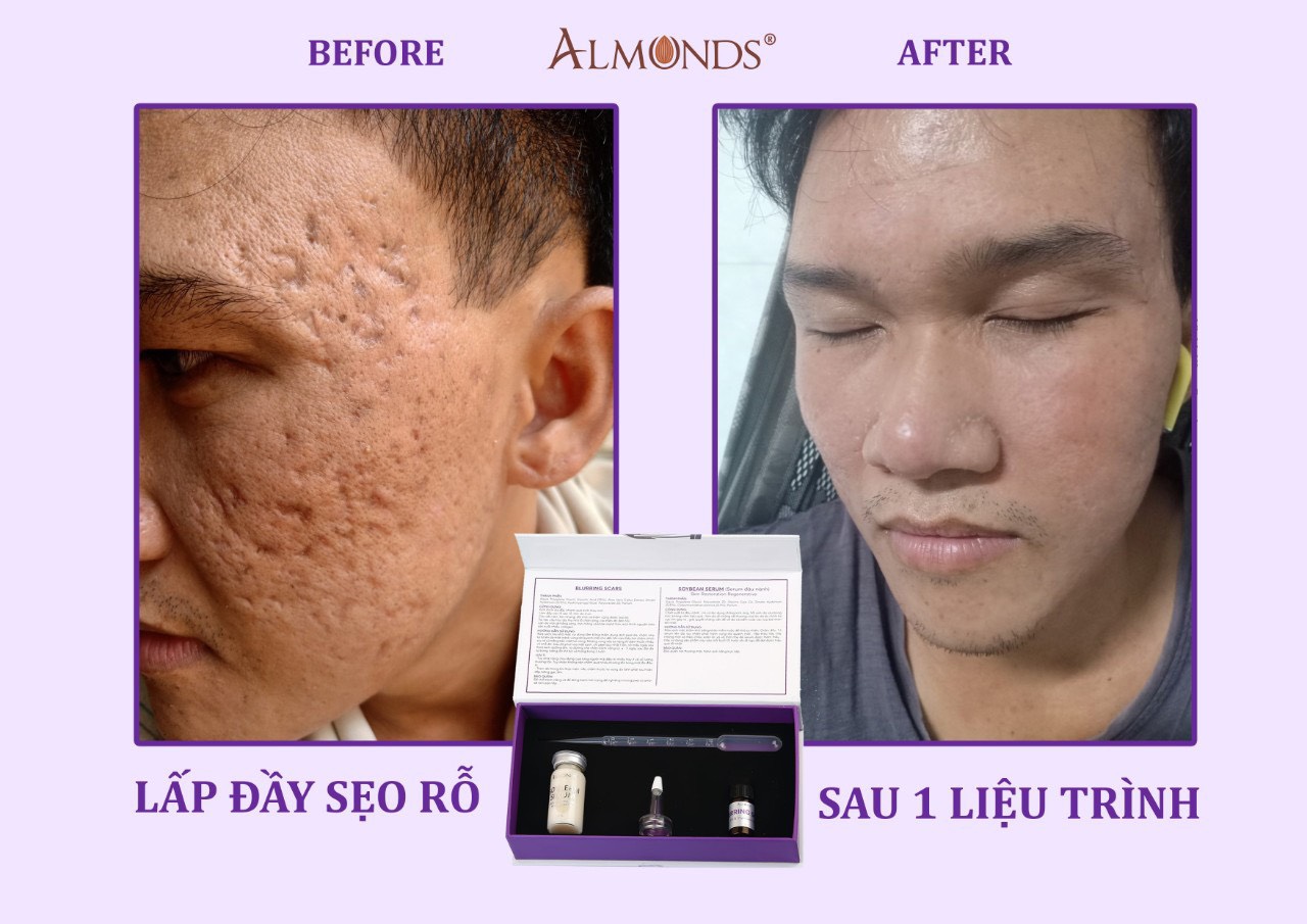 Làm đầy sẹo rỗ - giúp bạn lấp đầy sẹp rỗ lâu năm