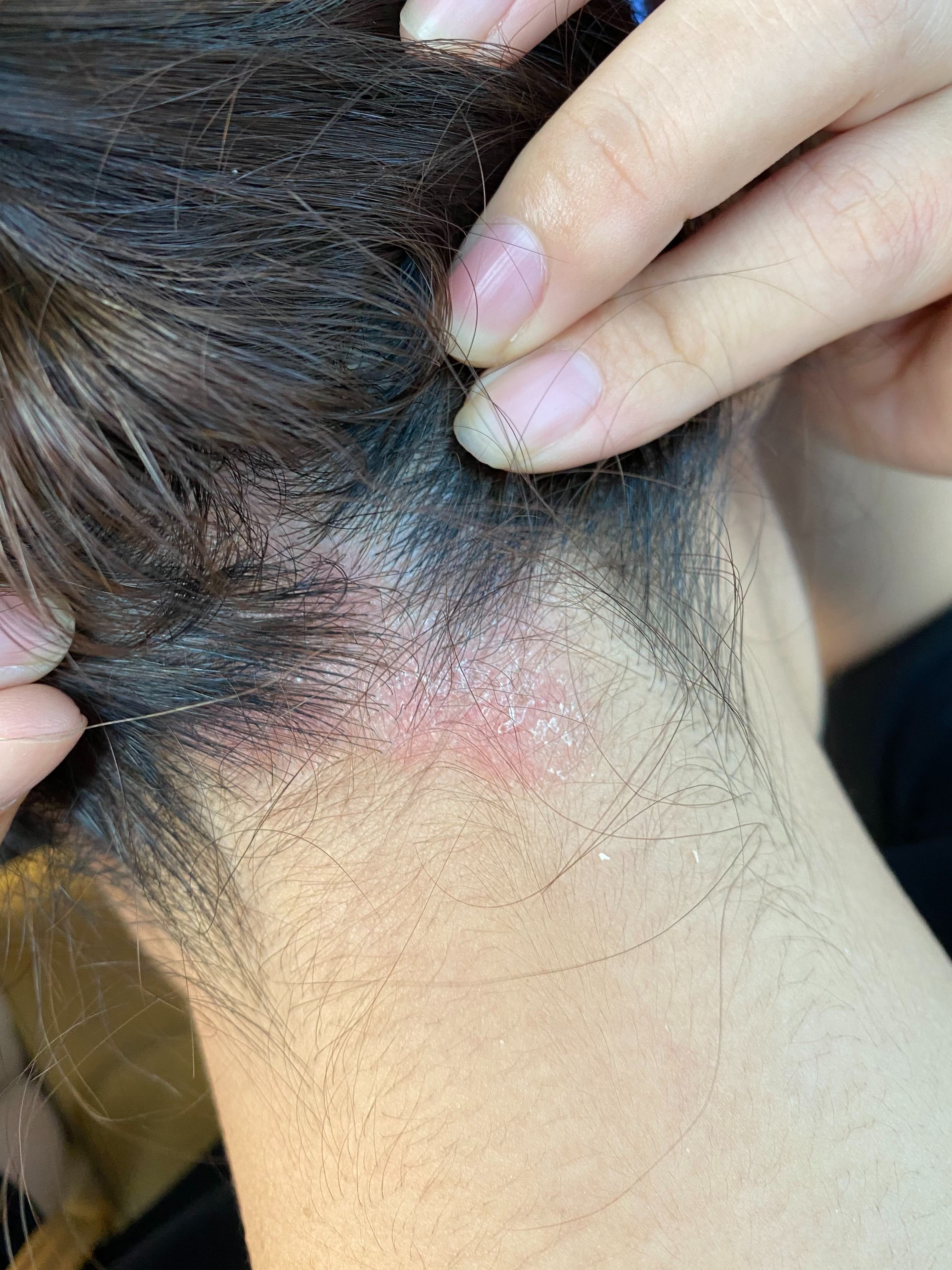 BÔi Vẩy Nến Da Đầu SẠCH Nấm Đầu, Nấm Tóc, Gàu Ngứa Mảng, kem cải thiện Các vấn đề Da liễu, Ngứa Gàu mảng, Á sừng tiết bã da đầu