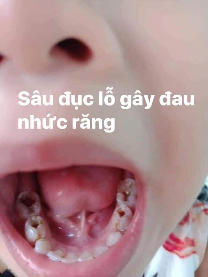 Sâu răng Nhật Dương