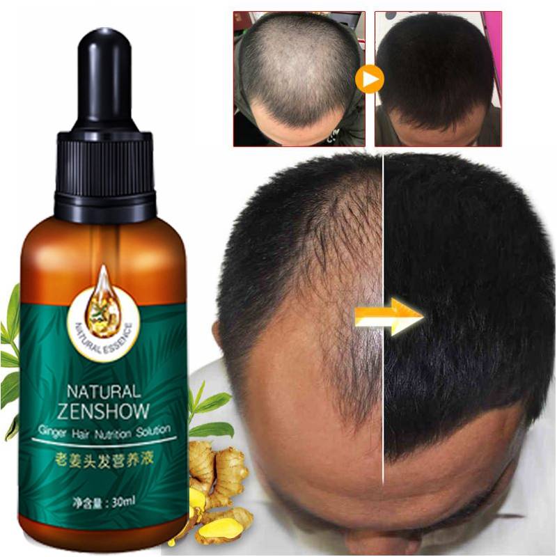 Tinh dầu kích mọc tóc nhanh ngăn ngừa rụng tóc chai tinh dầutinh chất giúp tóc mọc nhanh chống rụng tóc Tinh chất tăng trưởng tóc nhanh Hair Grower Dầu xả tóc Tinh chất ngăn ngừa rụng tóc cho nam và nữ 30ML
