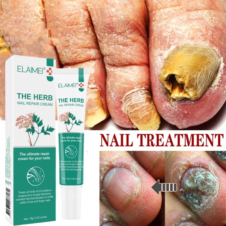 Chai gel chiết xuất từ thảo dược 20ml giúp loại bỏ nấm móng chân hiệu quả