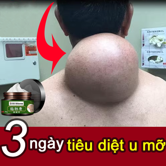 Kem tan u mỡ，thuốc bôi u mỡ， kem bôi sức khỏe kem dưỡng da kem bôi cho da ngứa ngáy bôi ngoài da 30g chuyên về ngứa do nhiễm nấm, giời leo, nấm, đặc tính viêm da Kem tan u mỡ loại bỏ u mỡ hiệu quả