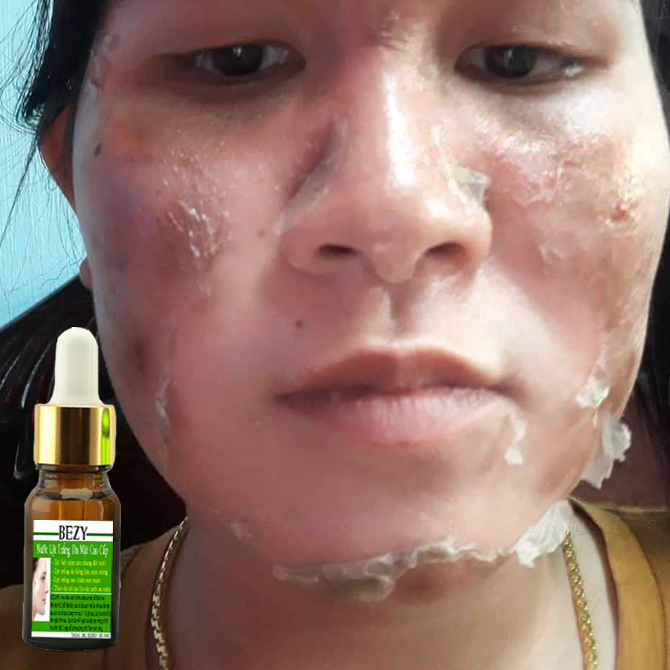 Lột bezy trắng da xóa mờ nám sạm lâu năm