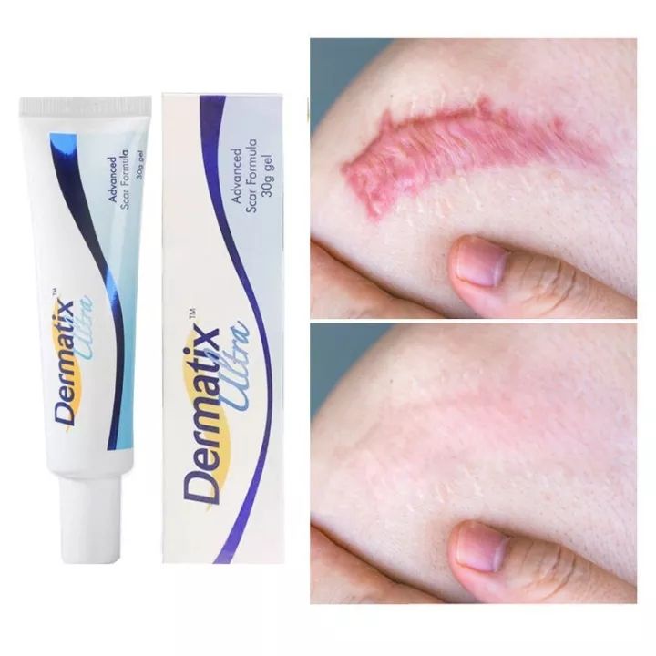 Dermatix Ultra Gel Làm Mờ Sẹo ThâmPha loãng vết bỏng vết sẹo cũ vết rỗ mụn và dấu ấn