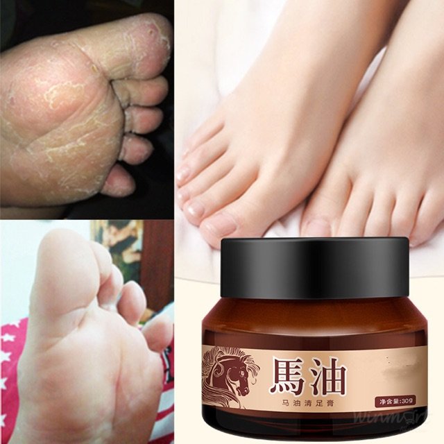 Kem Bôi Ngựa Nứt Gót Chân Nẻ Tay Chân Á Sừng Bong Da Hiệu Quả . Sáp bôi Vết nẻ, khô da hết nhanh, mùa đông này bán là sướng nhất luôn. Gia đình có người hay bị nẻ chân thì đừng quên sử dựng kem bôi nẻ này nhé