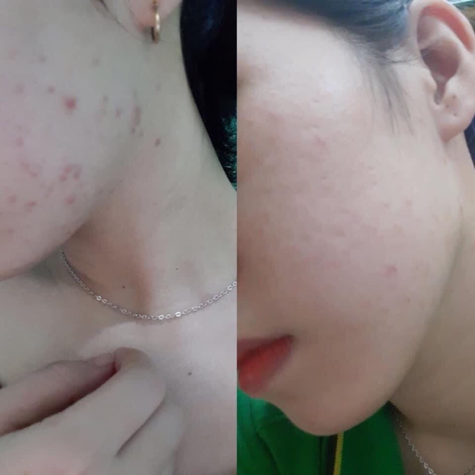 Kem trị mụn ht beauty
