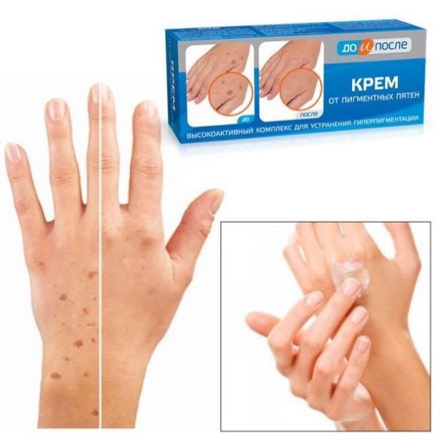 Kem Loại Bỏ Đồi Mồi Da Tay Nga Kpem 50ml, kem đồi mồi chính hãng nga