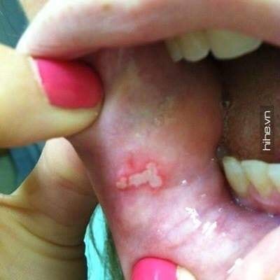 Hết nhiệt miệng khi đánh răng, súc họng với TINH DẦU DẠ THẢO LIÊN mỗi ngày