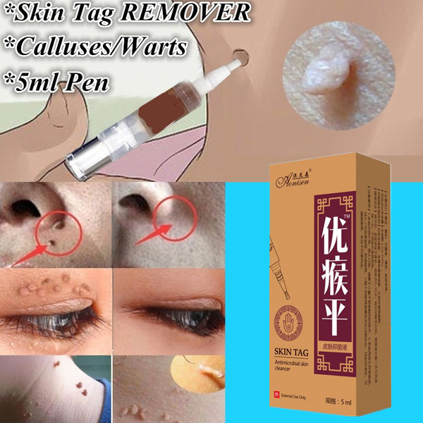 Kem bôi mụn thịt, MỤN nốt duồi, mụn cóc, , mụn cơm, nám tàn nhang hết bay nhanh trong nốt nhạc