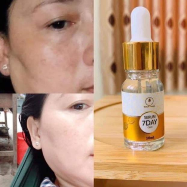 1 CHAI SERUM HUYẾT THANH TRUYỀN TRẮNG OLIC 7DAY XÓA TÀN NHANG , TRỊ NÁM HIỆU QUẢ