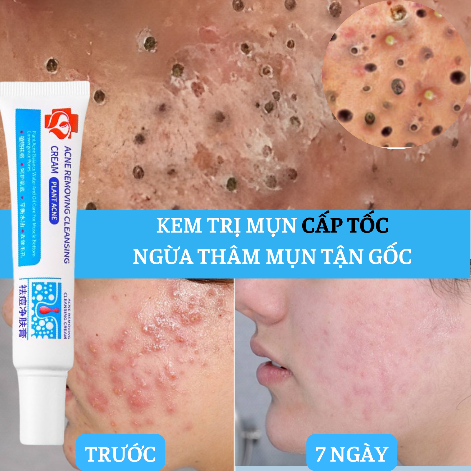 Kem dưỡng giảm mụn, ngăn ngừa vết thâm và ngăn mụn tái phát eelhoe loại bỏ mụn và vết thâm hoàn toàn, thu nhỏ lỗ chân lông 30g
