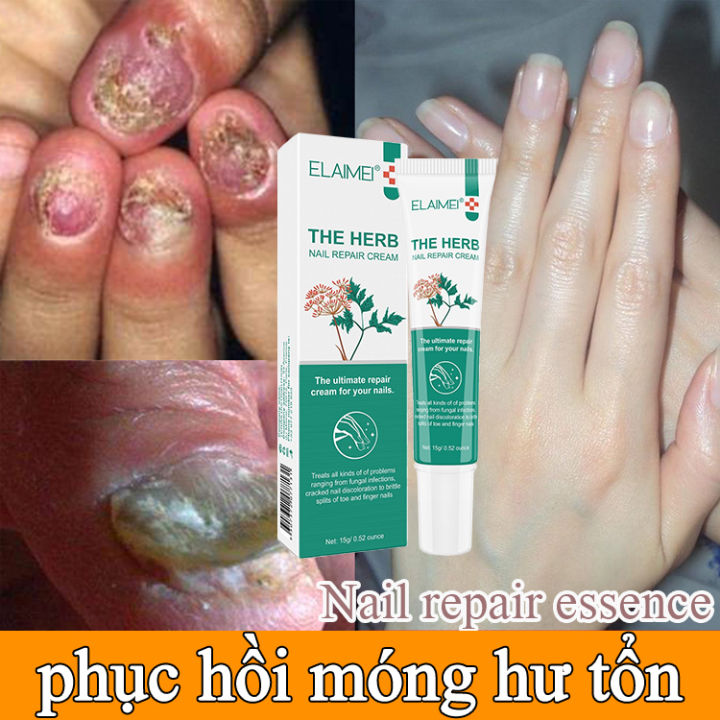 Móng kháng khuẩn 20g, Tinh chất phục hồi diệt nấm, Nấm móng phục hồi, Chất phục hồi diệt nấm nấm, Làm đẹp móng, phục hồi tổn thương móng, tinh chất thực vật phục hồi sâu, dưỡng móng tay dài và cứng