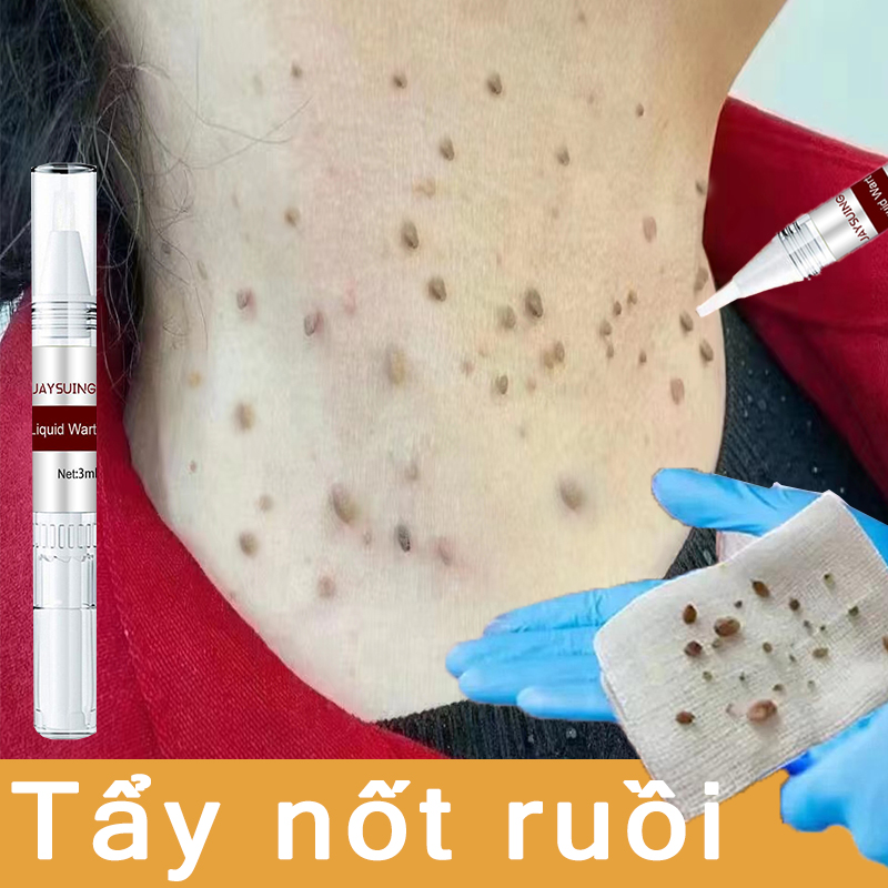 Tẩy nốt ruồi chấm nốt ruồi Loại bỏ mụn cóc, mụn cóc ,tàn nhangTẩy nốt ruồi xóa mụn ruồi trên mặt tàn nhang mụn cóc ruồi