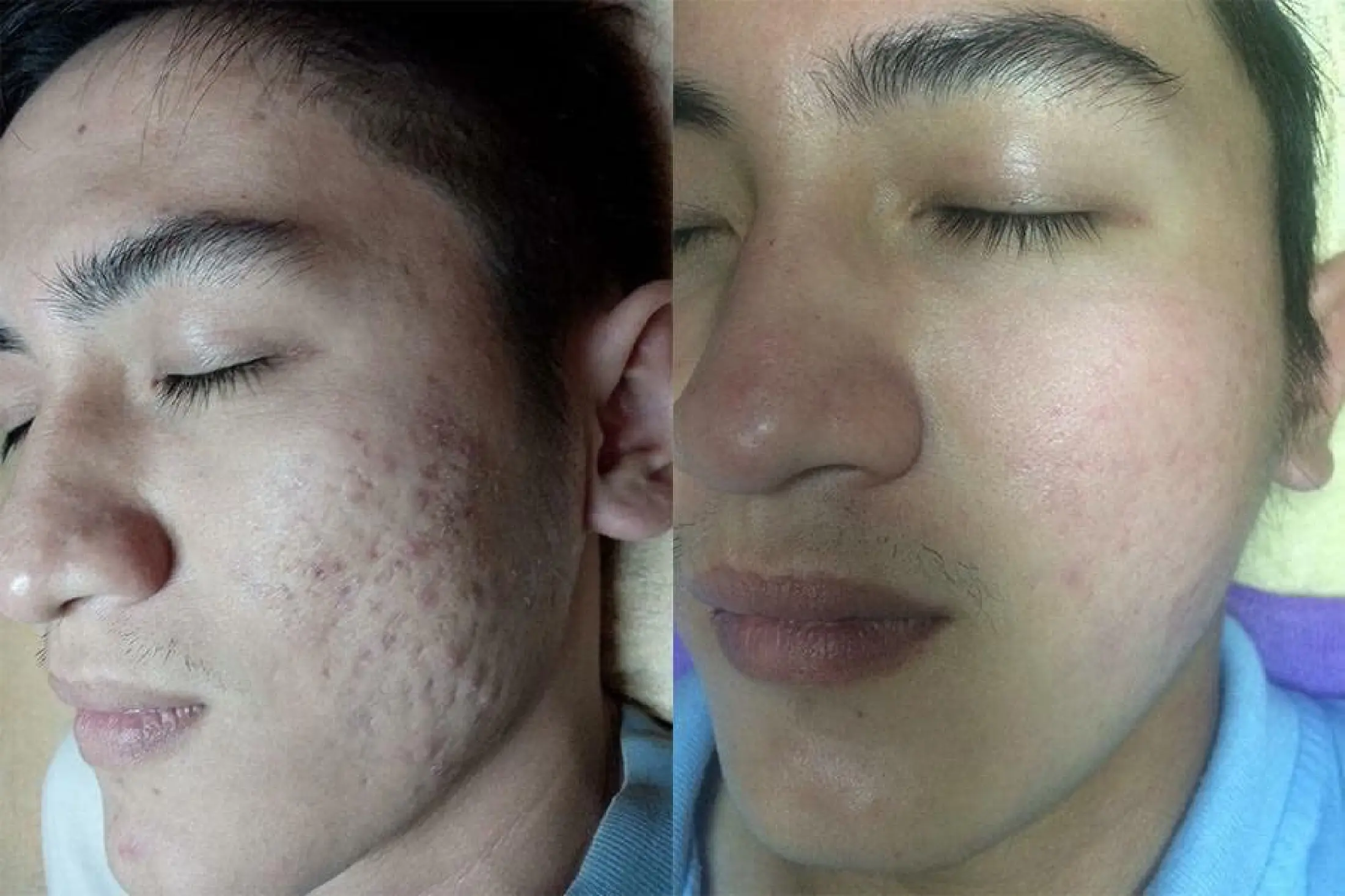 Serum quét sạch mụn edora