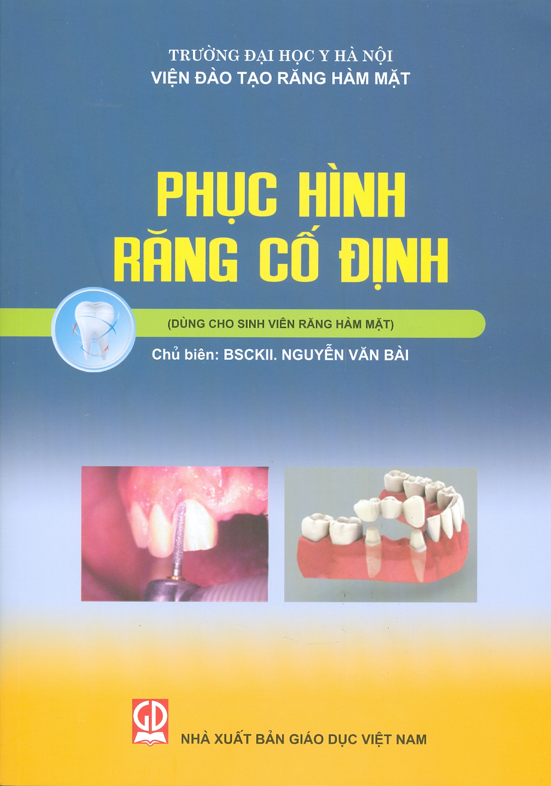 Phục hình răng cố định