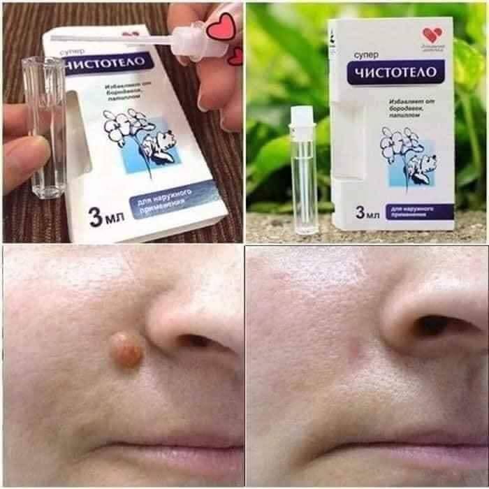 Gel tẩy mụn cóc nga