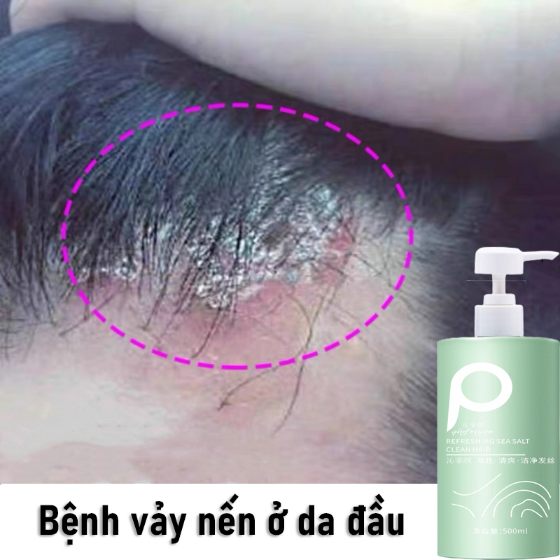 Dầu gội cho da đầu bị vảy nến ngứa da dầu nhiều gàu dầu gội kiềm dầu500ml dầu gội đầu