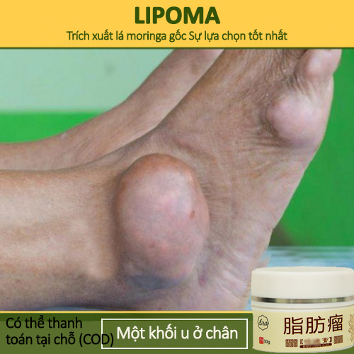 Kem bôi u bướu mỡ loại bỏ Bướu cổ tuyến giáp sưng to Loại bỏ u mỡ hiệu quả Loại bỏ u mỡ không đau