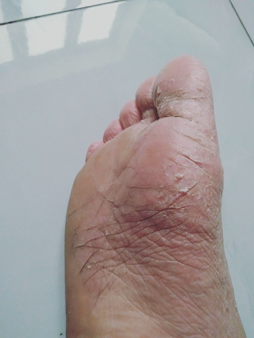 Da CHÀM KHÔ, Th.ảo Dượ.c QUÝ BÔi Chàm khô tróc vảy, Nứt Nẻ, Bong Chóc, Đau Rát Xót Tay Chân kem Cải thiện chăm sóc dưỡng
