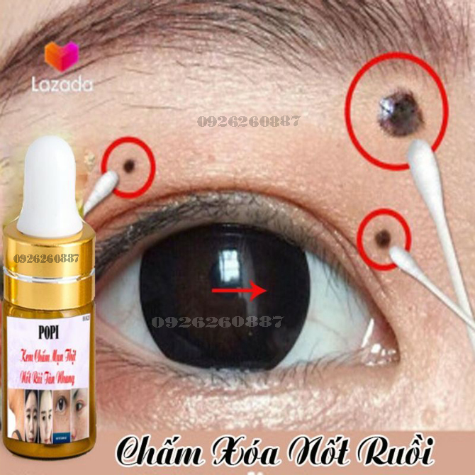 [FREESHIP] Kem Xoá Nốt Ruồi, Tàn Nhàng,Mụn Thịt,Mụt Cóc,Mắc Cá POPI hiệu quả nhanh (MACOIZY SHOP)