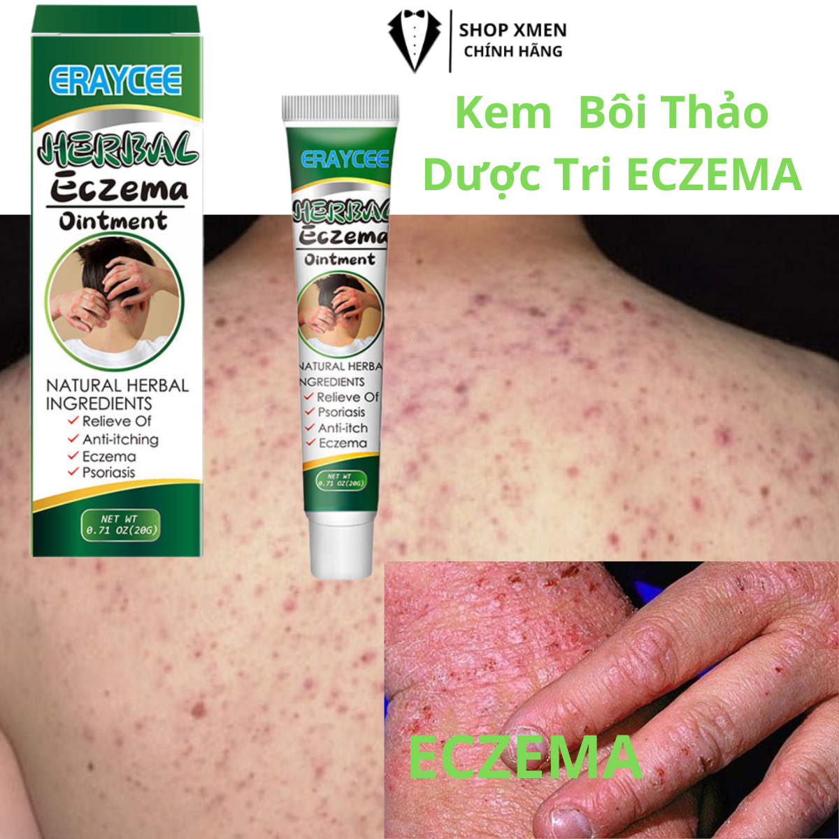 Kem bôi dứt điểm nấm da, vảy nến, eczema, á sừng, Kem bôi ECZEMA dứt điểm nấm ngứa, hắc lào, mề đay, viêm da cơ địa, viêm da tiếp xúc - thành phần thiên nhiên an toàn, hiệu quả nhanh chóng.