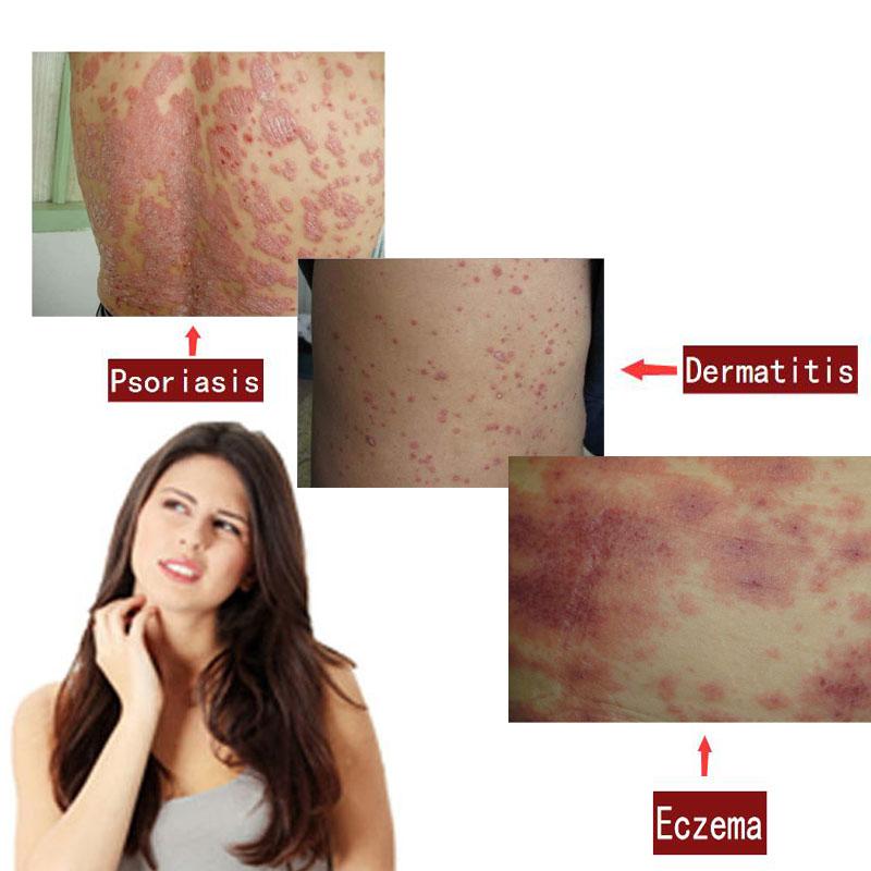 [hcm]zudaifu natural chinese herbal medicine cream eczema dermatitis psoriasis vitiligo antibacterial skin disease treatment 7